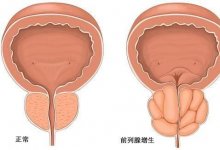 前列腺钙化什么原因导致？